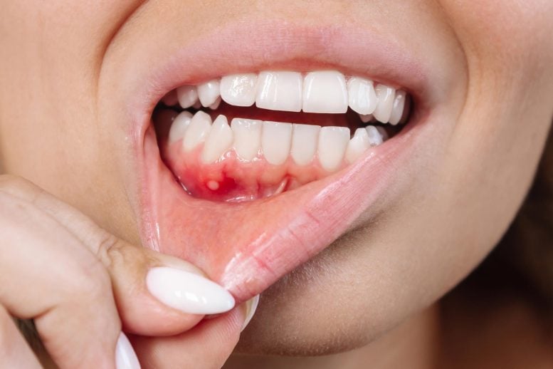 Gum Inflammation Ulcer Disease