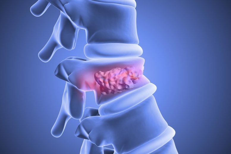 Vertebroplasty Spinal Vertebrae Stabilization Bone Cement